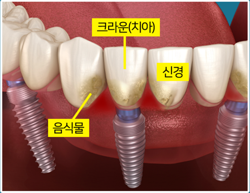 임플란트부작용