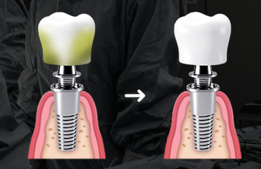 임플란트부작용